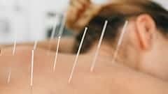 Βελονισμός: H Βιοϊατρική Προσέγγιση